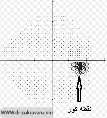 نقطه کور در آزمایش میدان بینایی